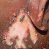Ustione infetta