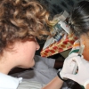 Mesoterapia