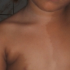 Diffuso nevo acromico