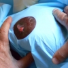 Medicazione della ferita chirurgica