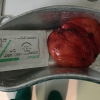 Grosso lipoma del dorso