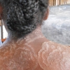 Tinea corporis