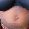 Tinea corporis 1